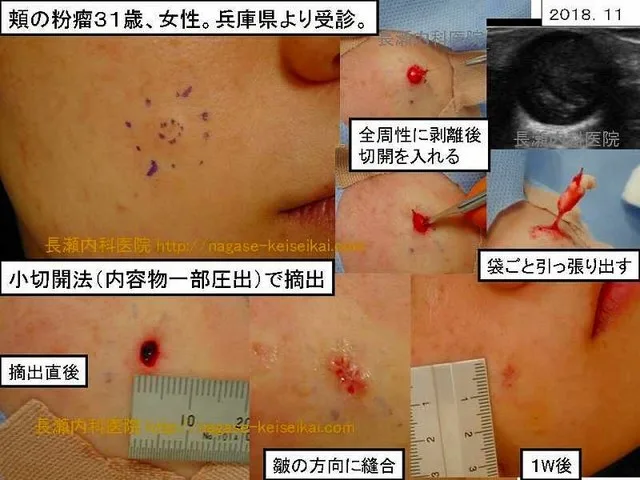 頬の粉瘤31歳、女性。兵庫県より受診。
