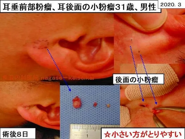 耳垂前部粉瘤、耳後面の小粉瘤31際、男性