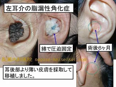 左耳介の脂漏性角化症