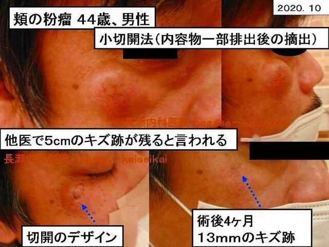 頬の粉瘤 44歳、男性