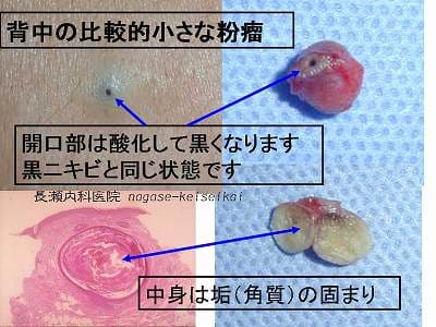 背中の比較的小さな粉瘤