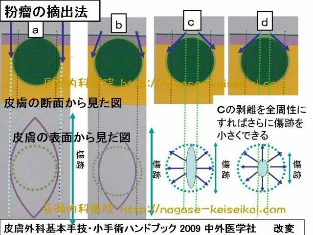 粉瘤の摘出法