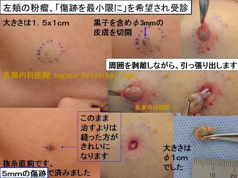 左頬の粉瘤、「傷跡を最小限に」を希望され受診