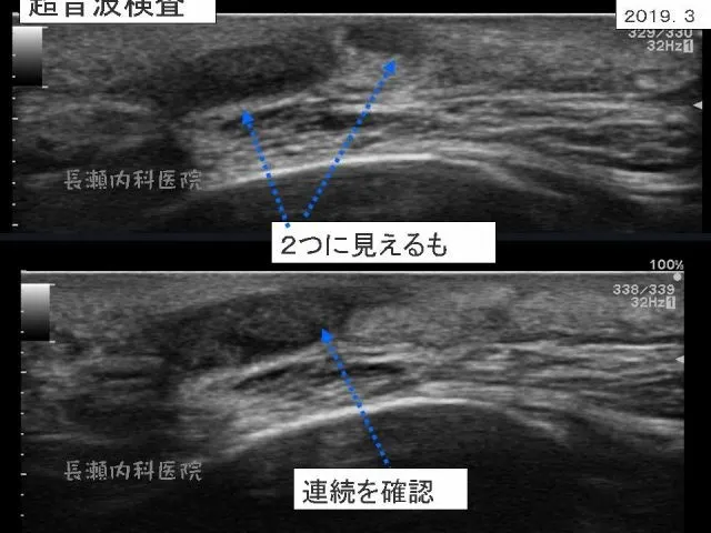 頬の粉瘤 37歳、男性