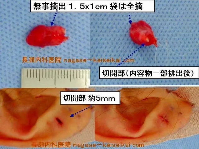 無事摘出 1.5×1cm 袋は全摘