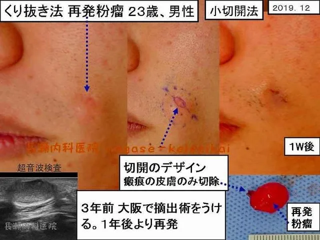 くり抜き法 再発粉瘤 23歳、男性