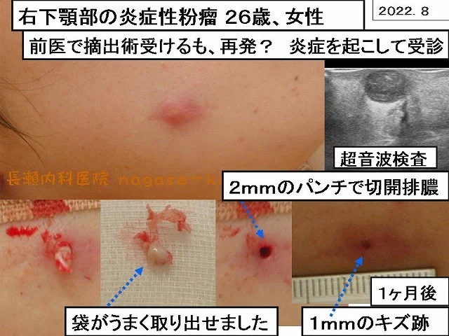 右下顎部の炎症性粉瘤 26歳、女性