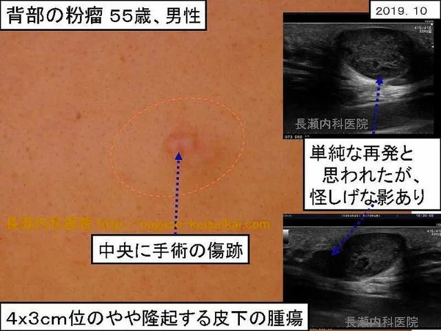 背部の粉瘤 55歳、男性