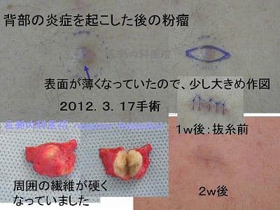 背部の炎症を起こした後の粉瘤