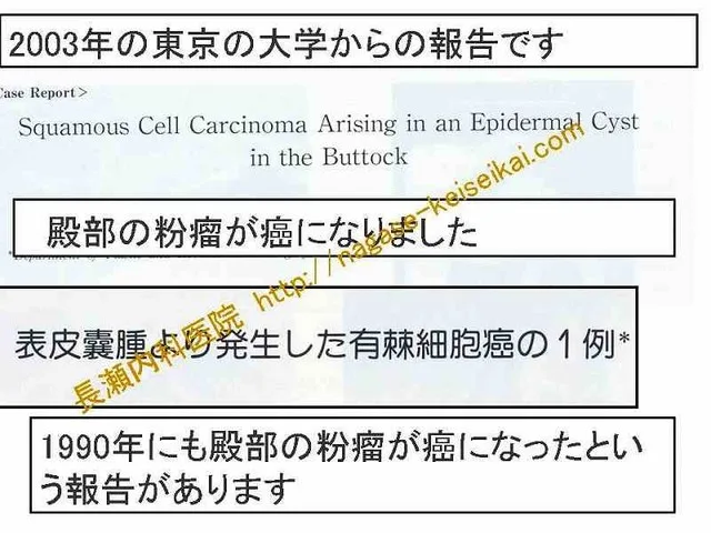 表皮嚢種より発生した有棘細胞癌の1例