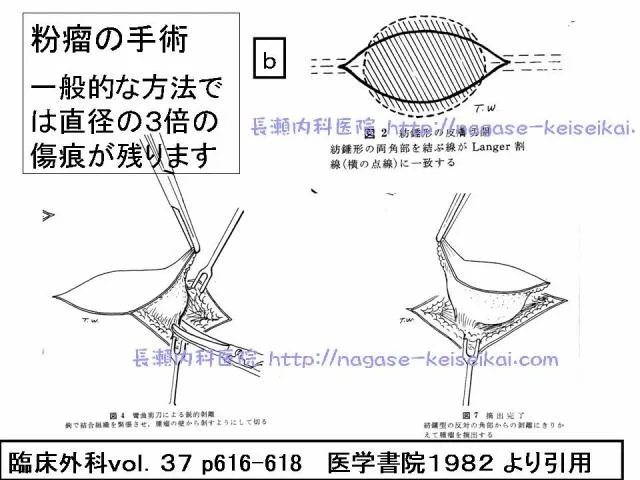 粉瘤の手術