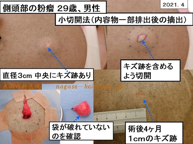 側頭部の粉瘤 29際、男性