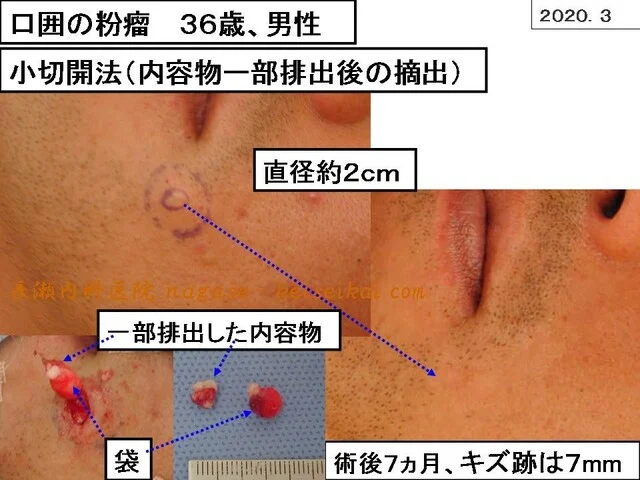 口囲の粉瘤 36歳、男性