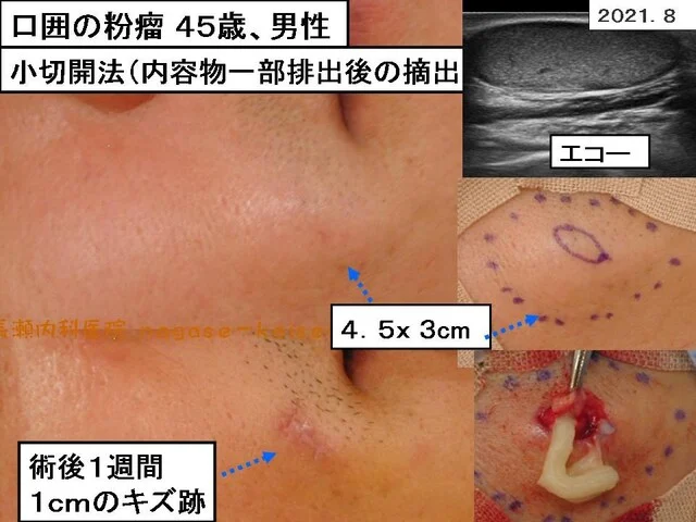 口囲の粉瘤 45歳、男性