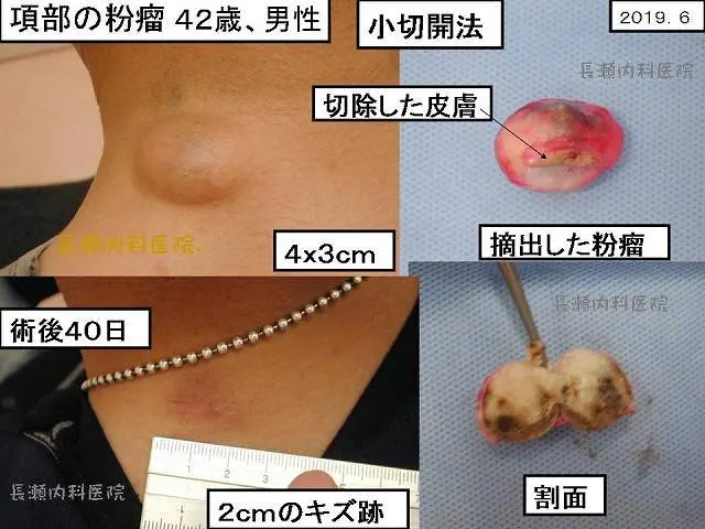 項部の粉瘤 42歳、男性