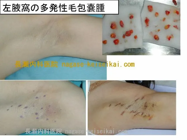 左腋窩の多発性毛包嚢腫