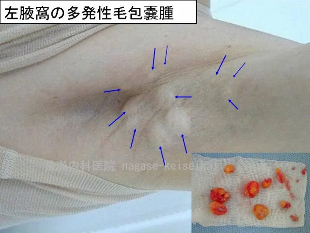 左腋窩の多発性毛包嚢腫