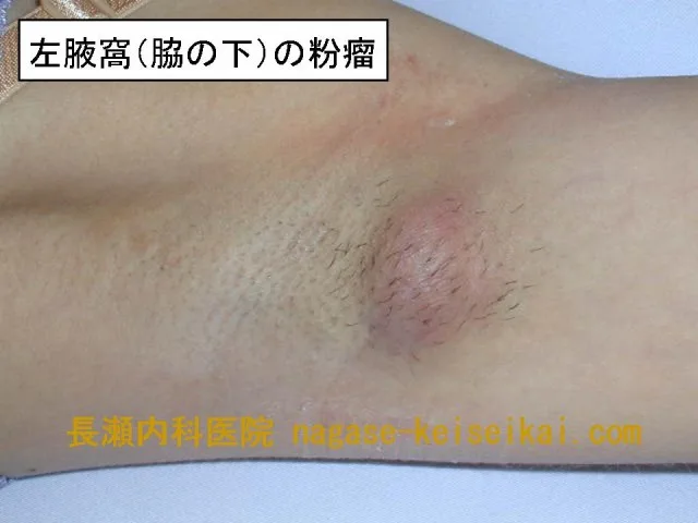 左腋窩の多発性毛包嚢腫