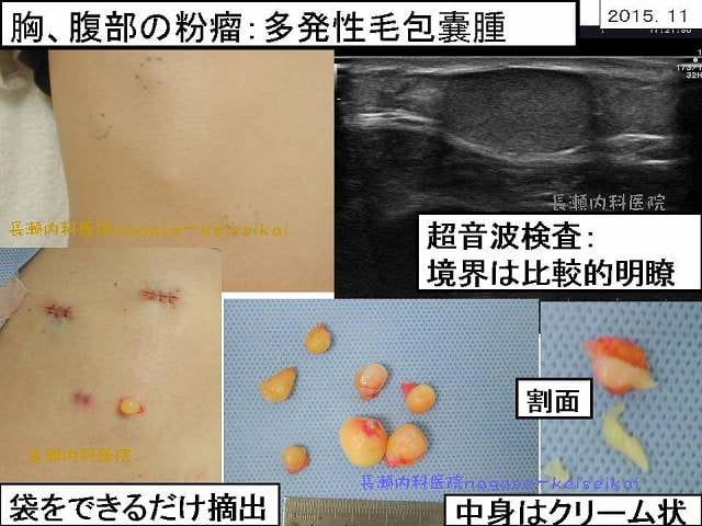 胸、腹部の粉瘤：多発性毛包嚢腫