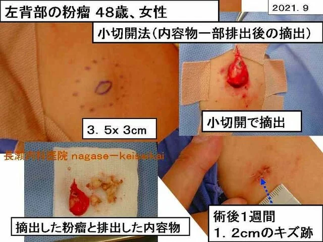 左背部の粉瘤 48歳、女性