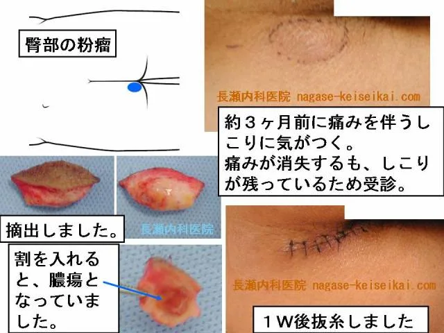 臀部の粉瘤