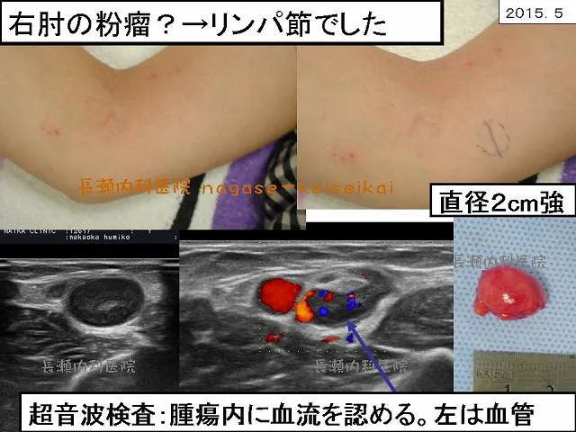 右肘の粉瘤？→リンパ節でした