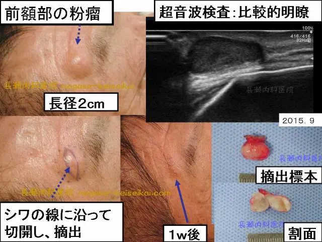 前額部の粉瘤