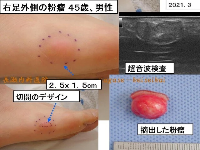 右足外側の粉瘤 45歳、男性