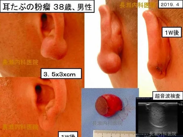 耳たぶの粉瘤 38歳、男性