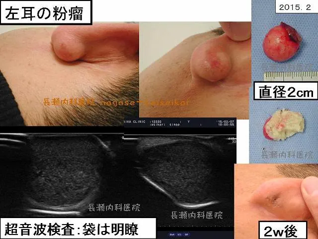 左耳の粉瘤