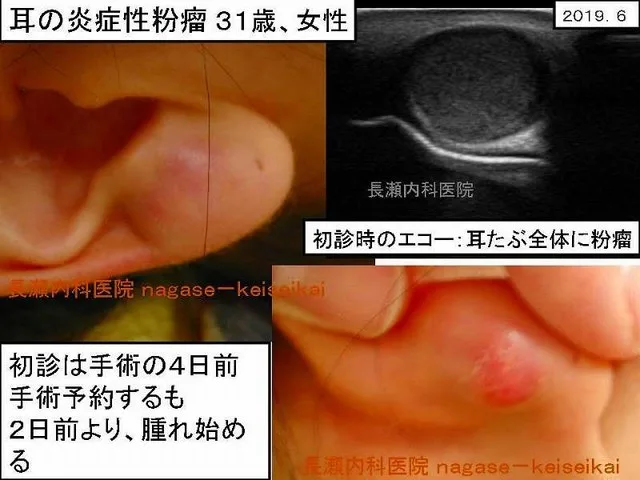 耳の炎症性粉瘤 31歳、女性