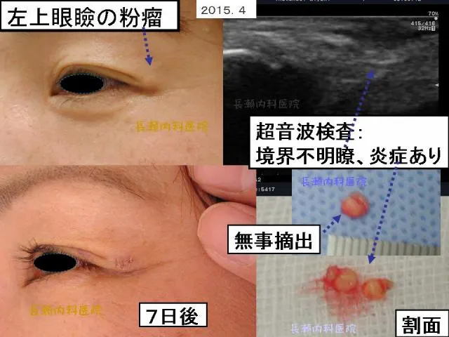 左上眼瞼の粉瘤