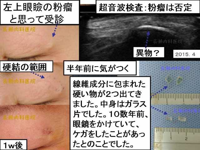 左上眼瞼の粉瘤と思って受診