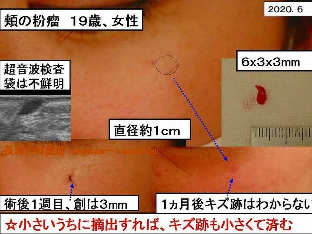 頬の粉瘤 19歳、女性