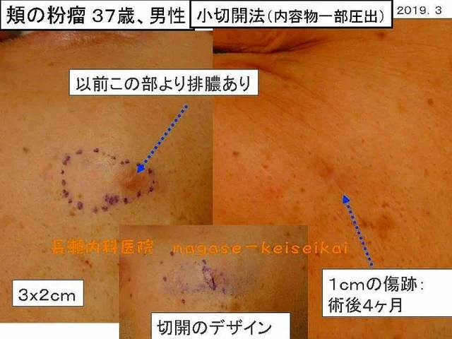 頬の粉瘤 37歳、男性