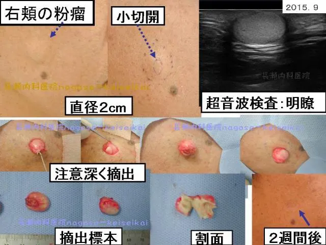 右頬の粉瘤