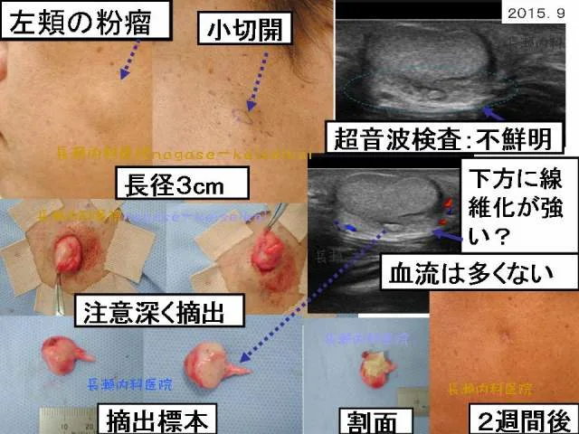 左頬の粉瘤