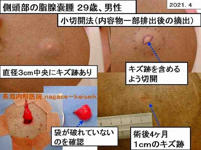 側頭部の脂腺嚢腫 29歳、男性