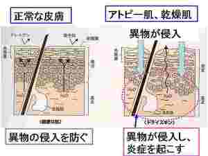 正常な皮膚・アトピー肌、乾燥肌