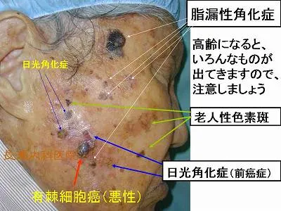 脂漏性角化症