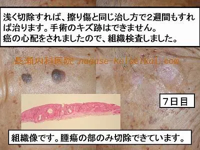 浅く切除すれば、擦り傷と同じ直し方で2週間もすれば治ります。手術のキズ跡はできません。癌の心配をされましたので、組織検査しました。