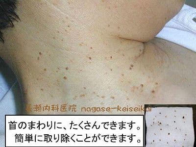 首のまわりに、たくさんできます。簡単に取り除くことができます。