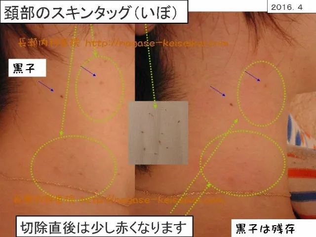 頚部のスキンタッグ（いぼ）